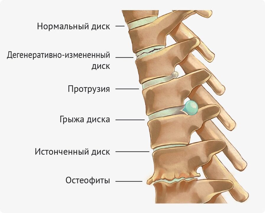 Nimme osteokondroosi kettade deformatsioonid