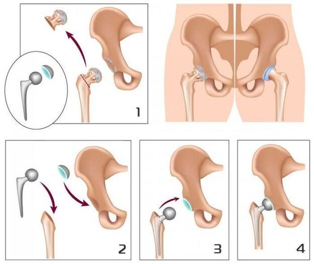 Valimisliigese asendamine proteesiga
