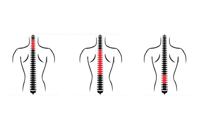 Kuidas osteokondroos avaldub
