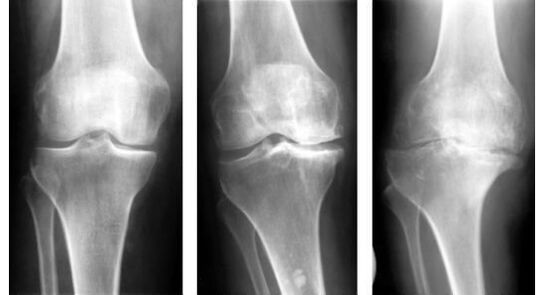 Põlveliigese artroosi tuvastamisel on kohustuslik diagnostiline meede röntgenuuring